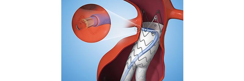 Securing Endografts For Abdominal Aortic Aneurysms With Flexible Shaft